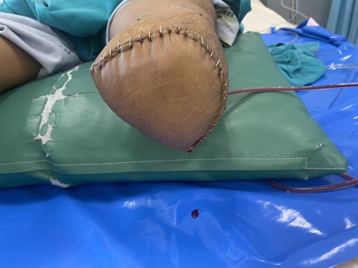 เบาหวาน ตัดขา เบาหวาน ตัดขา