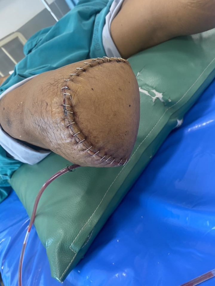 เบาหวาน ตัดขา เบาหวาน ตัดขา