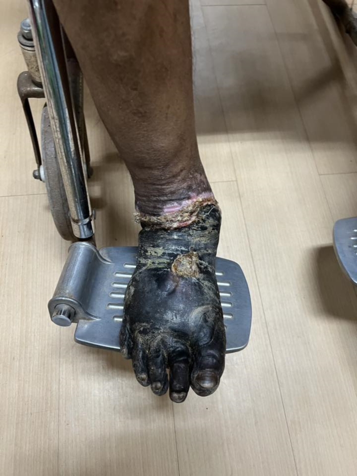 เบาหวาน ตัดขา เบาหวาน ตัดขา