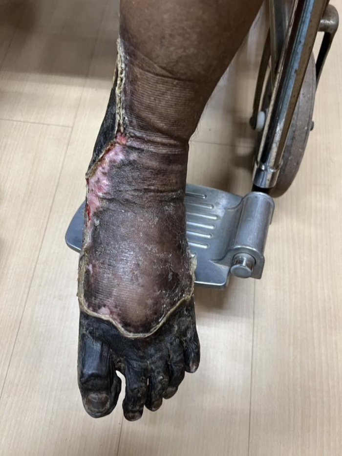 เบาหวาน ตัดขา เบาหวาน ตัดขา