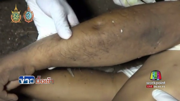 แมงมุมกัดตาย แมงมุมกัดตาย