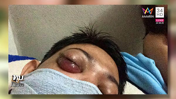 มะเร็งที่ตา มะเร็งที่ตา