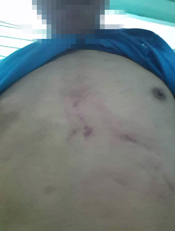 ต่อยม้ามแตก ต่อยม้ามแตก