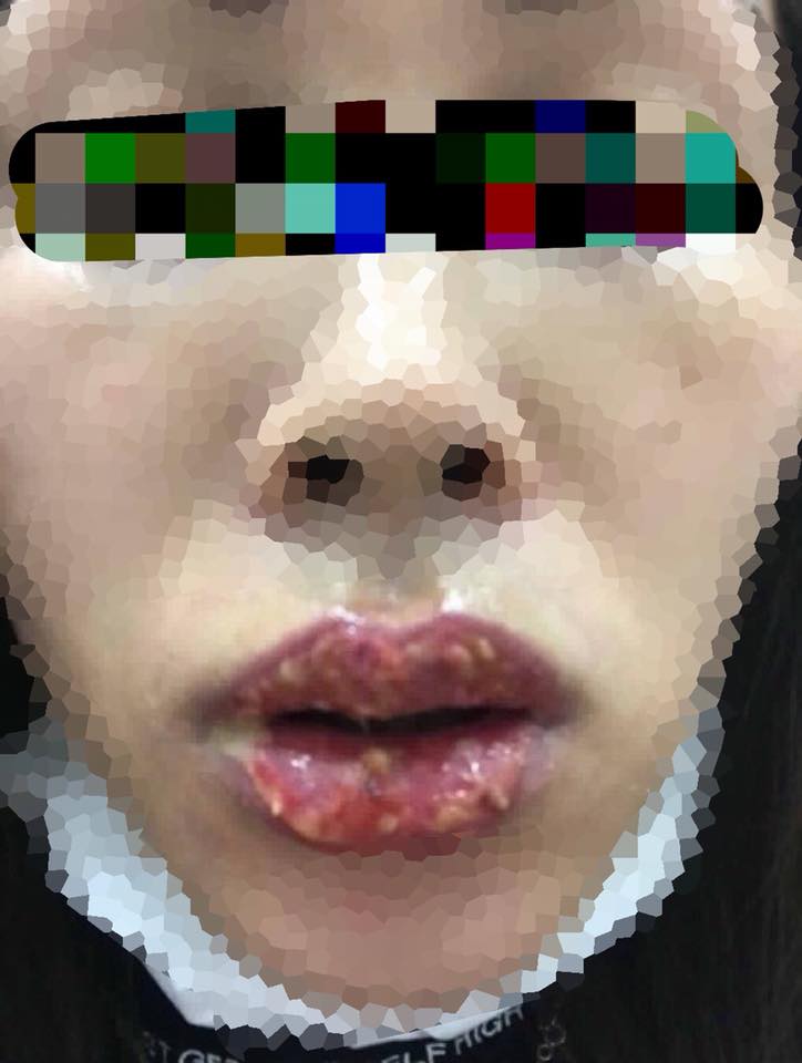 สักปากชมพู สักปากชมพู