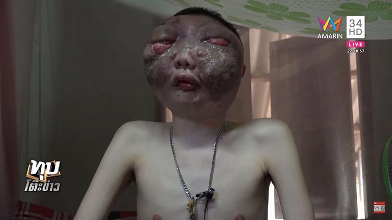 แฟนป่วยมะเร็ง แฟนป่วยมะเร็ง