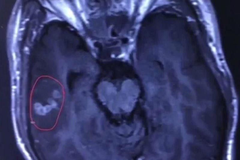 พยาธิในสมอง พยาธิในสมอง