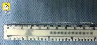 พยาธิในสมอง พยาธิในสมอง