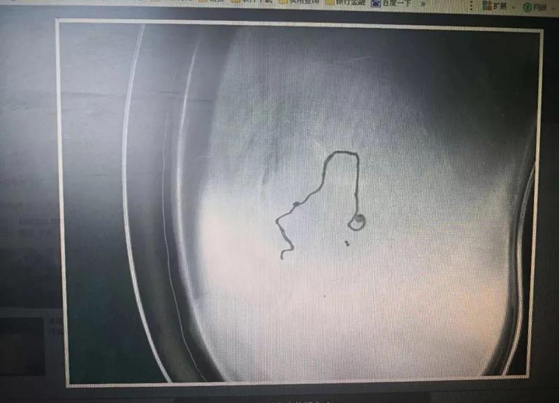 พยาธิในสมอง พยาธิในสมอง