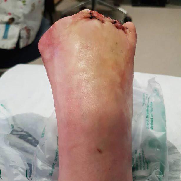 เท้าเน่า เท้าเน่า