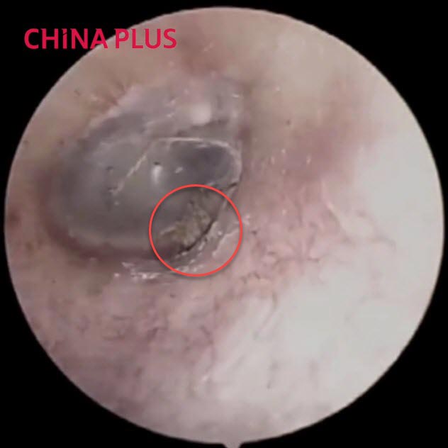 แมงมุมในหู แมงมุมในหู