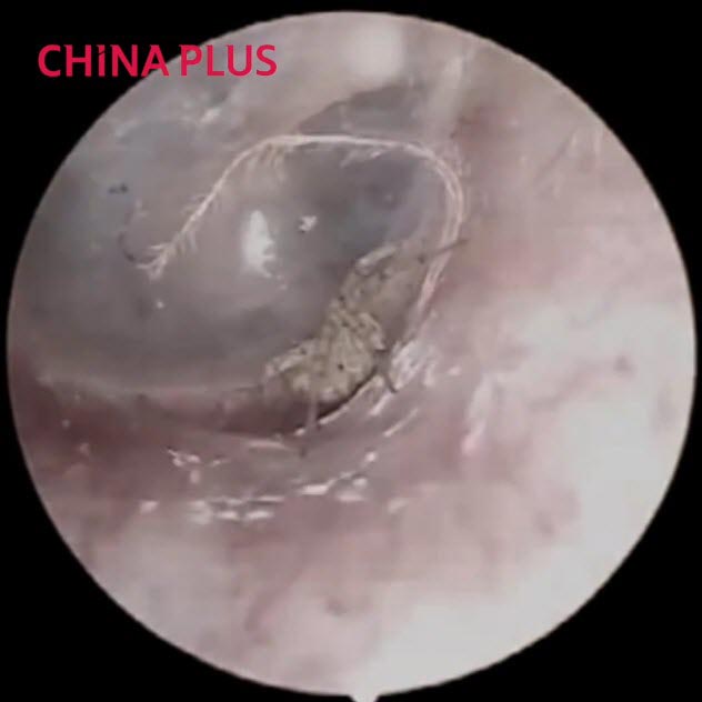 แมงมุมในหู แมงมุมในหู