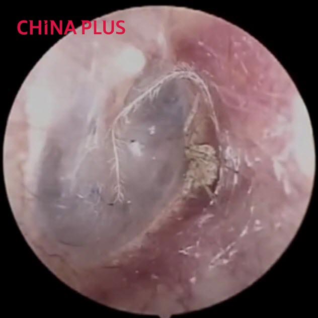 แมงมุมในหู แมงมุมในหู