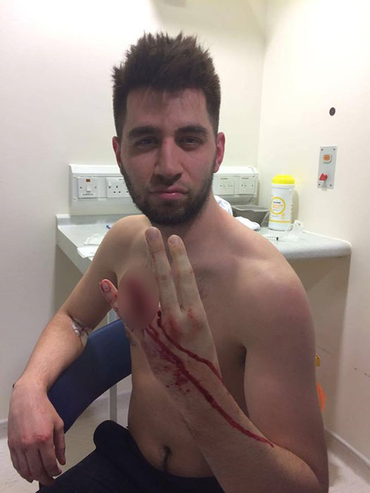 นิ้วขาด นิ้วขาด