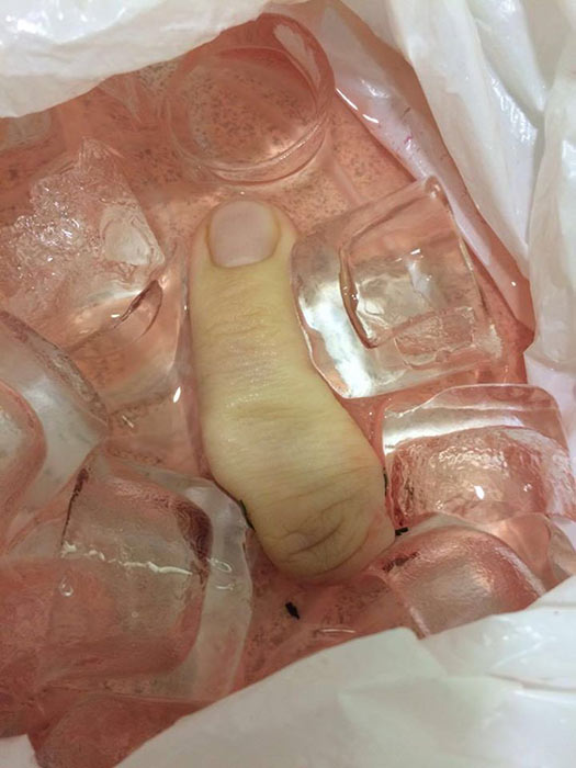 นิ้วขาด นิ้วขาด