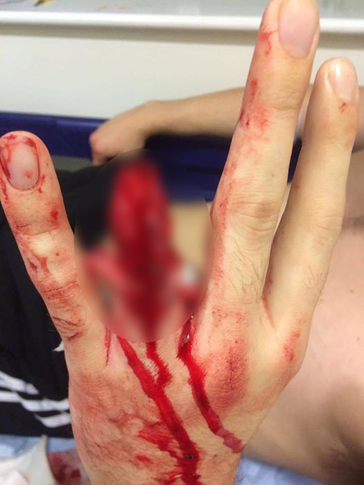 นิ้วขาด นิ้วขาด