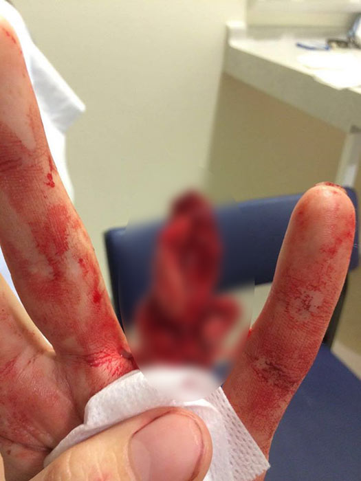 นิ้วขาด นิ้วขาด