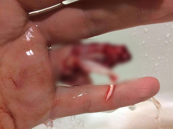 นิ้วขาด นิ้วขาด