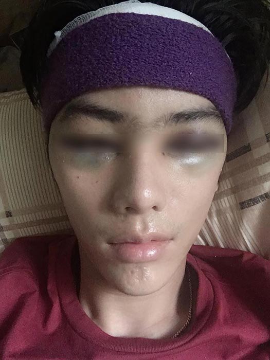 ศัลยกรรมซิลิโคนหน้าผาก ศัลยกรรมซิลิโคนหน้าผาก