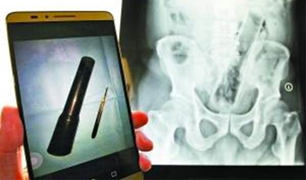 แพทย์ผ่าตัดไฟฉายจากก้น แพทย์ผ่าตัดไฟฉายจากก้น