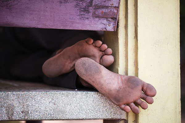 เท้าเหม็น เท้าเหม็น