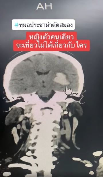 เส้นเลือดในสมองแตก เส้นเลือดในสมองแตก