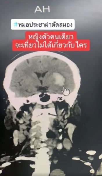 เส้นเลือดในสมองแตก เส้นเลือดในสมองแตก