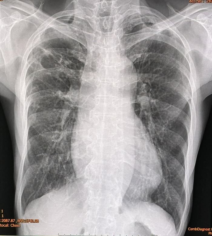 วัณโรคปอดเทียม วัณโรคปอดเทียม