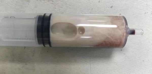 ชายปวดท้องเข้า รพ. สะพรึงเจาะเลือดกลายเป็นแบบนี้ พบกินเมนูโปรด 7 วันติด ชายปวดท้องเข้า รพ. สะพรึงเจาะเลือดกลายเป็นแบบนี้ พบกินเมนูโปรด 7 วันติด