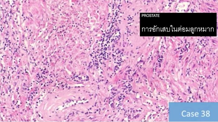 วัคซีนโควิด วัคซีนโควิด