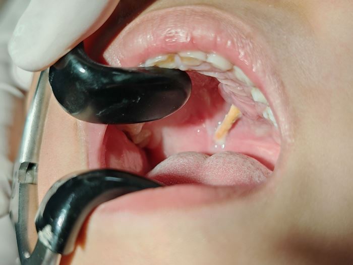 เด็ก 6 ขวบ ถูกเศษไม้แทงเพดานปาก 3 เดือน เด็ก 6 ขวบ ถูกเศษไม้แทงเพดานปาก 3 เดือน