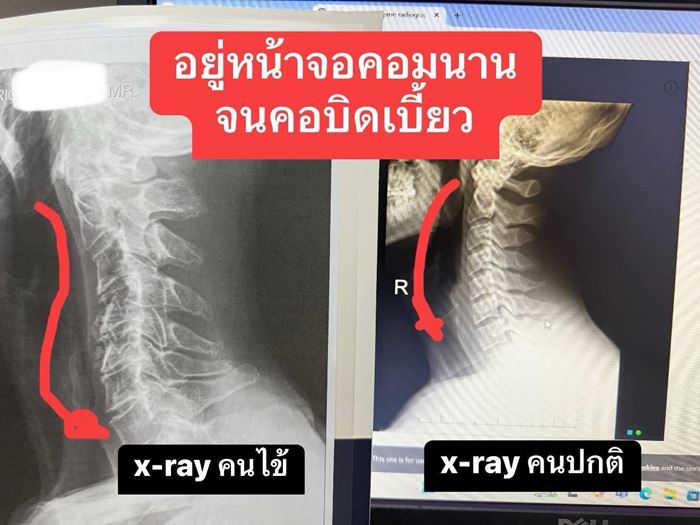 ชายปวดหัว 6 เดือนไม่หาย เอกซเรย์ดูรู้เลย กระดูกคอเบี้ยว ชายปวดหัว 6 เดือนไม่หาย เอกซเรย์ดูรู้เลย กระดูกคอเบี้ยว