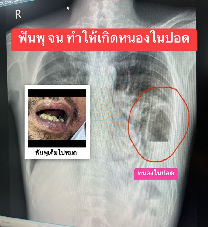 กินแต่เหล้า ฟันไม่แปรง หนองในปอด กินแต่เหล้า ฟันไม่แปรง หนองในปอด