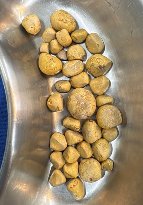 หมอผ่านิ่วในไตเต็มท้อง 35 ก้อน ต้นเหตุเพราะเครื่องดื่มโปรด หมอผ่านิ่วในไตเต็มท้อง 35 ก้อน ต้นเหตุเพราะเครื่องดื่มโปรด