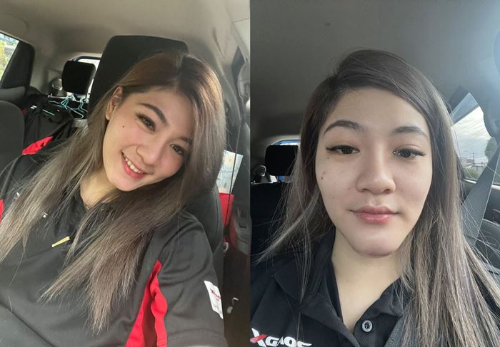 สาวแชร์ประสบการณ์แพ้ฟิลเลอร์ ปากบวม สุดทรมาน สาวแชร์ประสบการณ์แพ้ฟิลเลอร์ ปากบวม สุดทรมาน