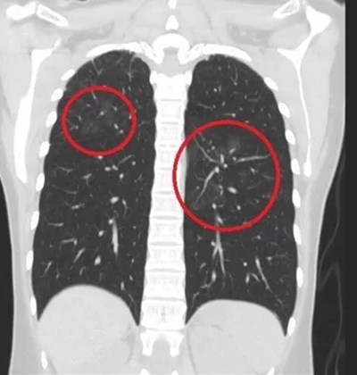 ครูอนุบาลสาวไม่สูบบุหรี่ เจอก้อนเนื้อในปอดนับสิบ เผยเหตุไม่คาดคิด ครูอนุบาลสาวไม่สูบบุหรี่ เจอก้อนเนื้อในปอดนับสิบ เผยเหตุไม่คาดคิด