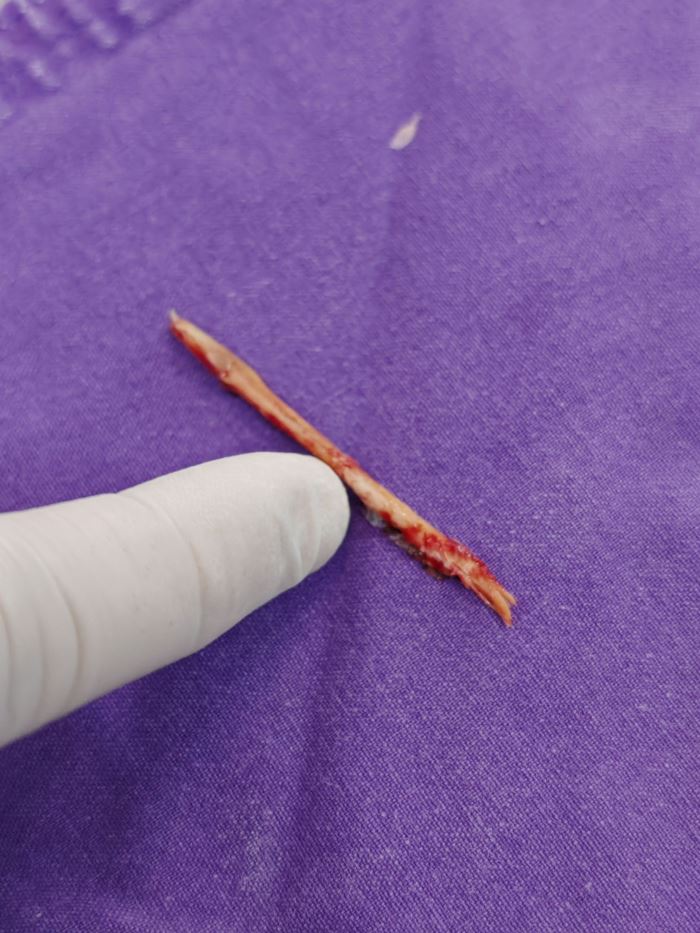 เด็ก 6 ขวบ ถูกเศษไม้แทงเพดานปาก 3 เดือน เด็ก 6 ขวบ ถูกเศษไม้แทงเพดานปาก 3 เดือน