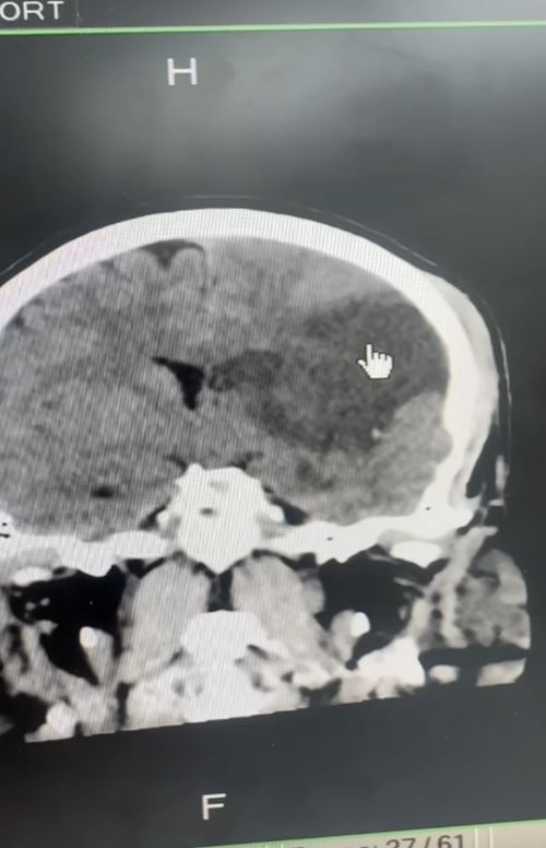 ผัวให้เมียนวด สุดท้ายตื่นมาแขนขาอ่อนแรง สมองตาย ผัวให้เมียนวด สุดท้ายตื่นมาแขนขาอ่อนแรง สมองตาย