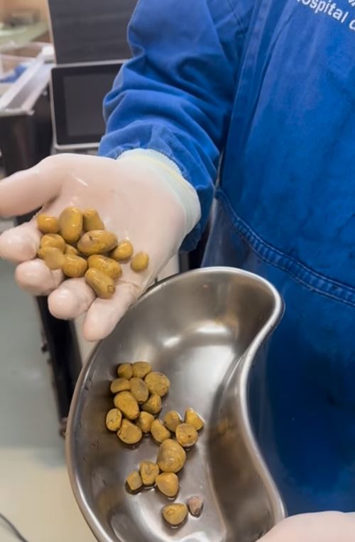 หมอผ่านิ่วในไตเต็มท้อง 35 ก้อน ต้นเหตุเพราะเครื่องดื่มโปรด หมอผ่านิ่วในไตเต็มท้อง 35 ก้อน ต้นเหตุเพราะเครื่องดื่มโปรด