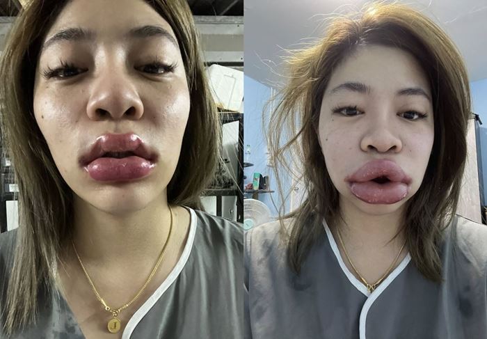 สาวแชร์ประสบการณ์แพ้ฟิลเลอร์ ปากบวม สุดทรมาน สาวแชร์ประสบการณ์แพ้ฟิลเลอร์ ปากบวม สุดทรมาน