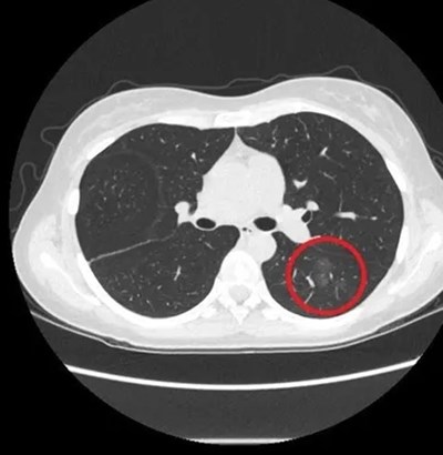 ครูอนุบาลสาวไม่สูบบุหรี่ เจอก้อนเนื้อในปอดนับสิบ เผยเหตุไม่คาดคิด ครูอนุบาลสาวไม่สูบบุหรี่ เจอก้อนเนื้อในปอดนับสิบ เผยเหตุไม่คาดคิด