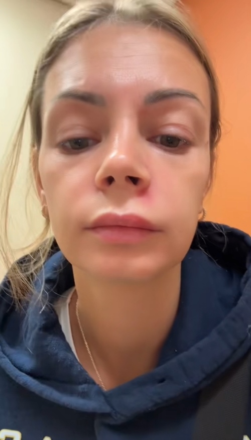 หญิงบีบสิวจนเป็นอัมพาตครึ่งหน้า หญิงบีบสิวจนเป็นอัมพาตครึ่งหน้า