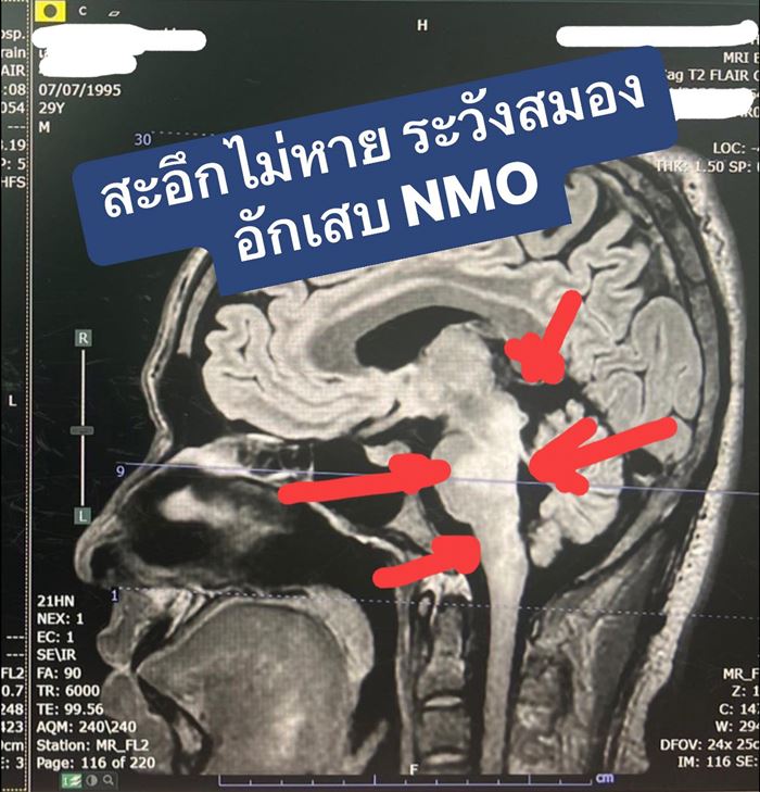 สะอึกไม่หาย สาเหตุจากโรคเกี่ยวกับสมอง สะอึกไม่หาย สาเหตุจากโรคเกี่ยวกับสมอง