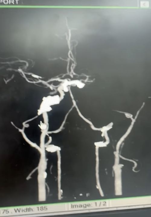 ผัวให้เมียนวด สุดท้ายตื่นมาแขนขาอ่อนแรง สมองตาย ผัวให้เมียนวด สุดท้ายตื่นมาแขนขาอ่อนแรง สมองตาย