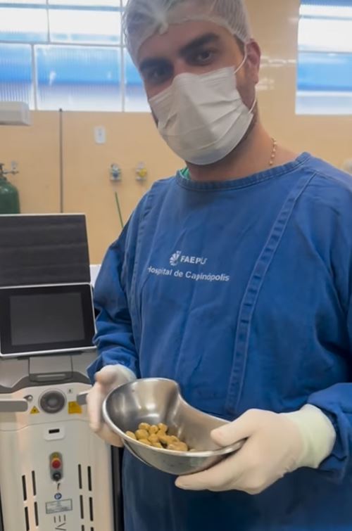 หมอผ่านิ่วในไตเต็มท้อง 35 ก้อน ต้นเหตุเพราะเครื่องดื่มโปรด หมอผ่านิ่วในไตเต็มท้อง 35 ก้อน ต้นเหตุเพราะเครื่องดื่มโปรด