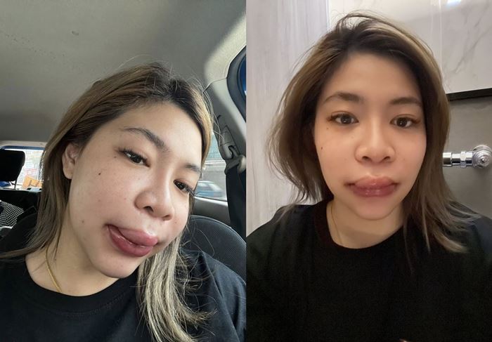 สาวแชร์ประสบการณ์แพ้ฟิลเลอร์ ปากบวม สุดทรมาน สาวแชร์ประสบการณ์แพ้ฟิลเลอร์ ปากบวม สุดทรมาน