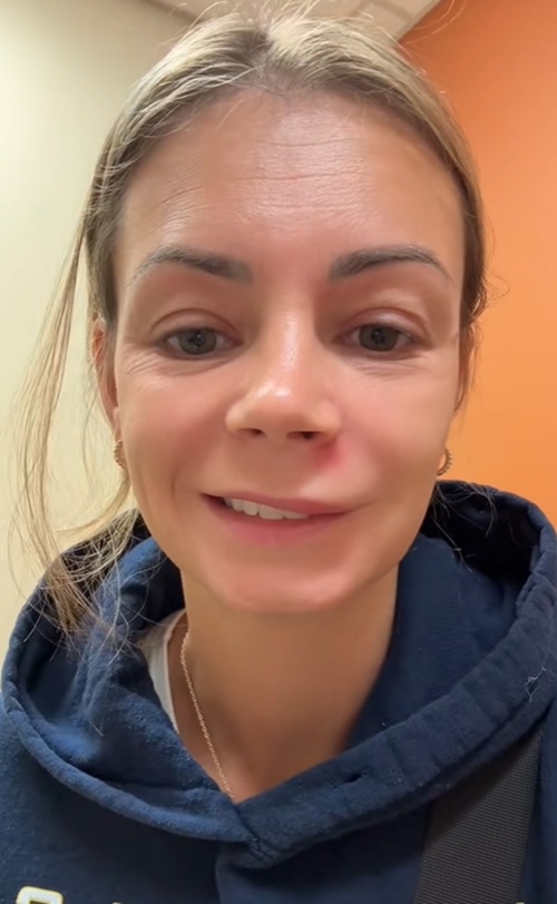 หญิงบีบสิวจนเป็นอัมพาตครึ่งหน้า หญิงบีบสิวจนเป็นอัมพาตครึ่งหน้า