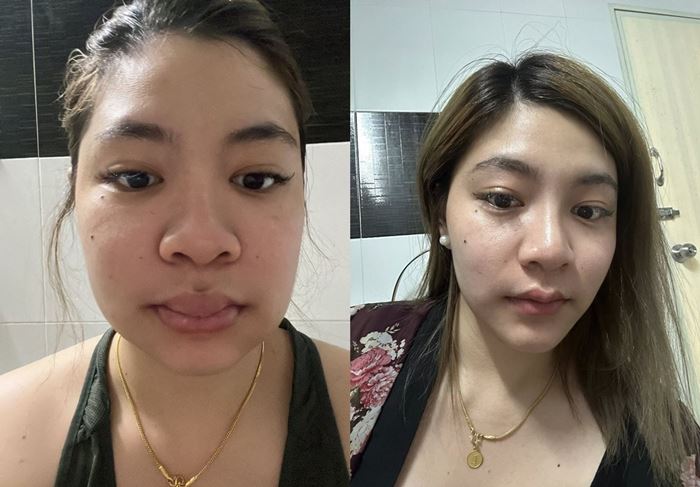 สาวแชร์ประสบการณ์แพ้ฟิลเลอร์ ปากบวม สุดทรมาน สาวแชร์ประสบการณ์แพ้ฟิลเลอร์ ปากบวม สุดทรมาน