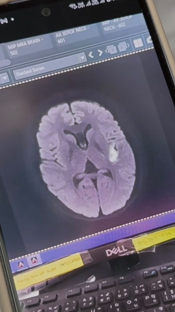 หมอเล่าเคส ตังตัง นัฐรุจี ป่วยเป็นสโตรก-พูดไม่ได้ เตือนระวังจุดเล็ก ๆ หมอเล่าเคส ตังตัง นัฐรุจี ป่วยเป็นสโตรก-พูดไม่ได้ เตือนระวังจุดเล็ก ๆ