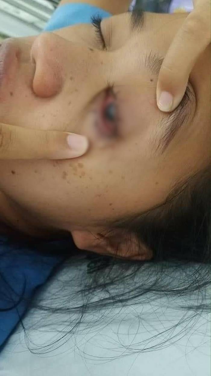 คอนแทคเลนส์ คอนแทคเลนส์