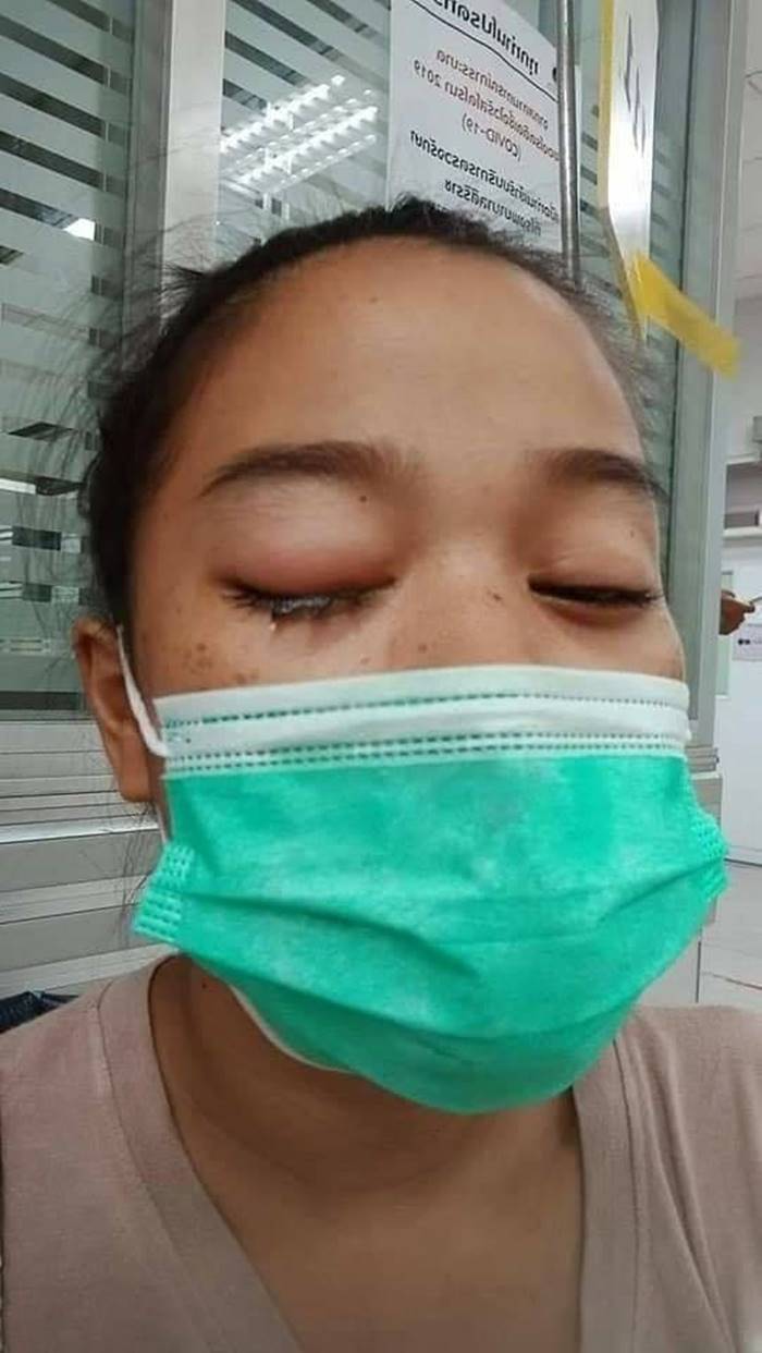 คอนแทคเลนส์ คอนแทคเลนส์